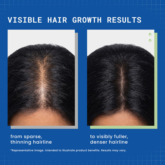 DermDoc 3% Redensyl,4% Anagain Hair Growth Roll-On Serum - image 2