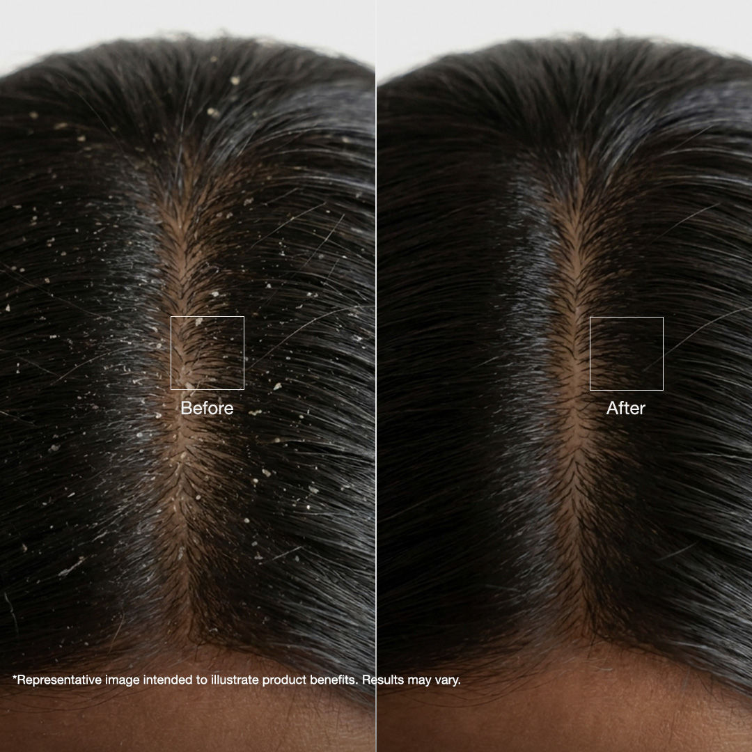 Alps Goodness Tea Tree Oil, Hyaluronic Acid & Ketoconazole Anti Dandruff Scalp Serum For Oily Scalp (30 ml) - image 3