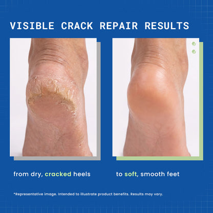 DermDoc by Purplle 20% Urea Foot Cream (100 gm) - image 2