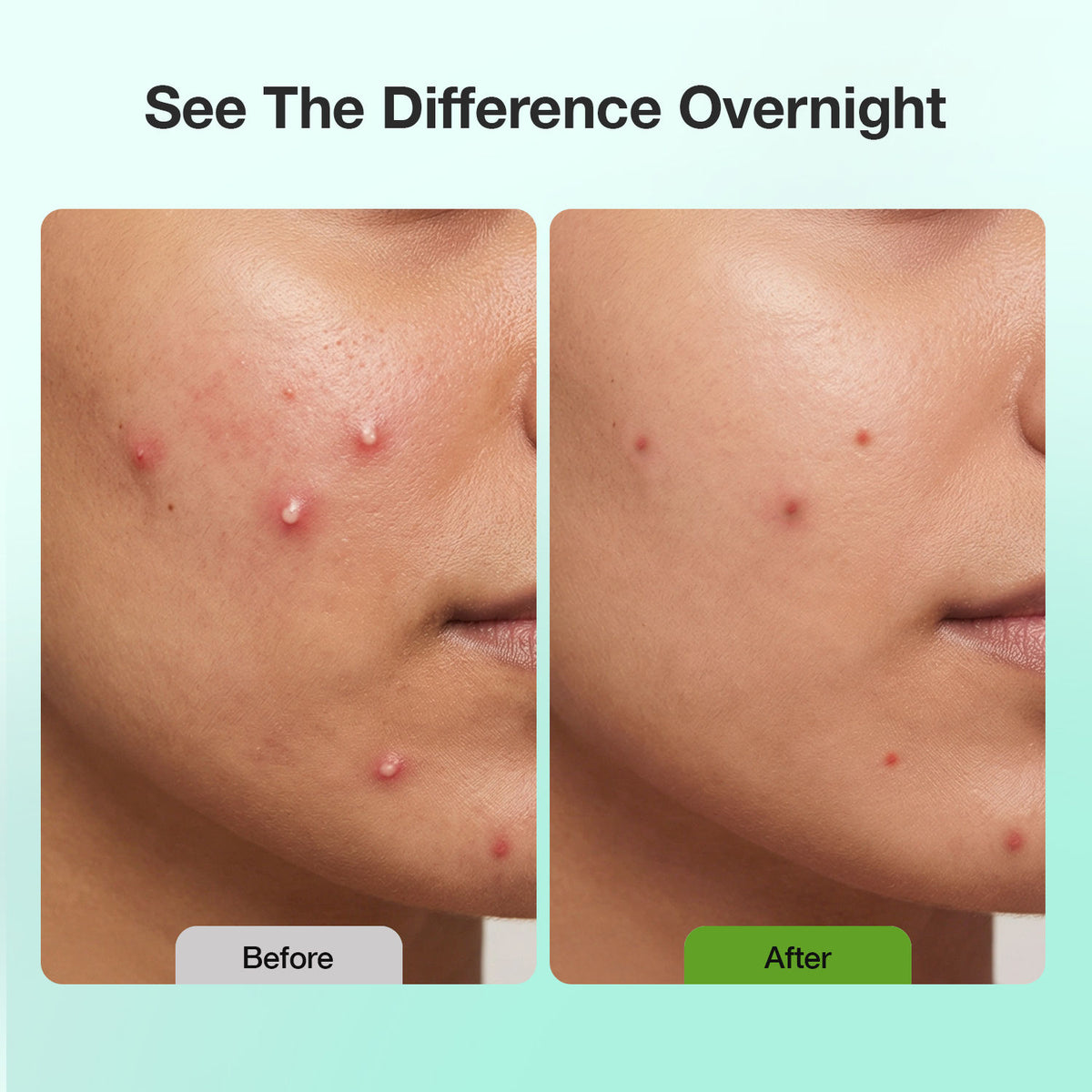 Good Vibes Acne Clear Pimple Patch | Hydrocolloid Patches for Acne & Pimples | Cica, Neem & Salicylic Acid | Absorbs Pus & Oil | Reduces Redness, Shrinks Pimples Fast | Overnight Spot Treatment for Face 36 Patches - Good Vibes image 2